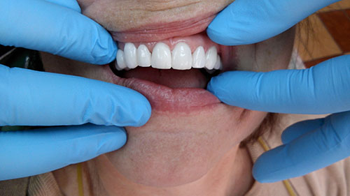 Tijuana Dentist Sirconia Full Bridge Top - After